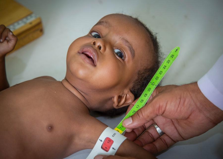 Malnutrizione Yemen