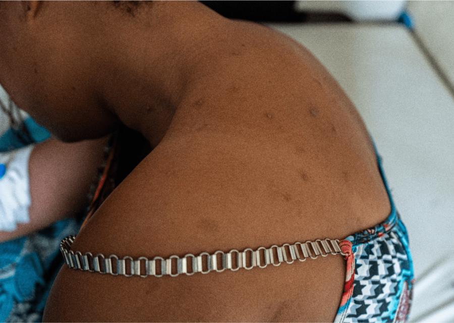 Vaiolo delle scimmie immagine di schiena di donna con sintomi di MPOX